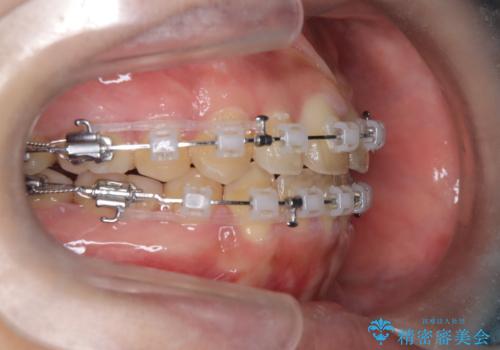 【抜歯矯正】クリア装置で1年半の治療中