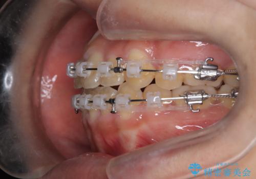【抜歯矯正】クリア装置で1年半の治療中