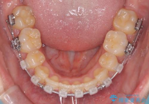 【抜歯矯正】クリア装置で1年半の治療中