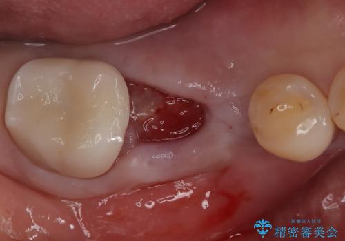 【インプラント】奥歯でしっかり物を噛みたい。の治療前