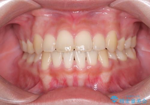 【抜歯矯正】クリア装置で1年半の症例 治療後