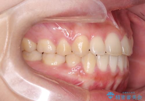【抜歯矯正】クリア装置で1年半の治療後