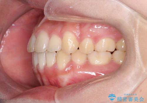 【抜歯矯正】クリア装置で1年半の治療後