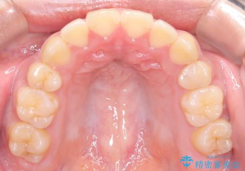 【抜歯矯正】クリア装置で1年半の治療後