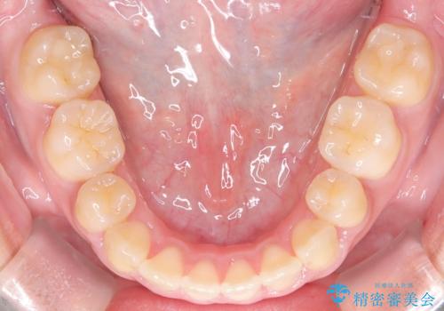 【抜歯矯正】クリア装置で1年半の治療後