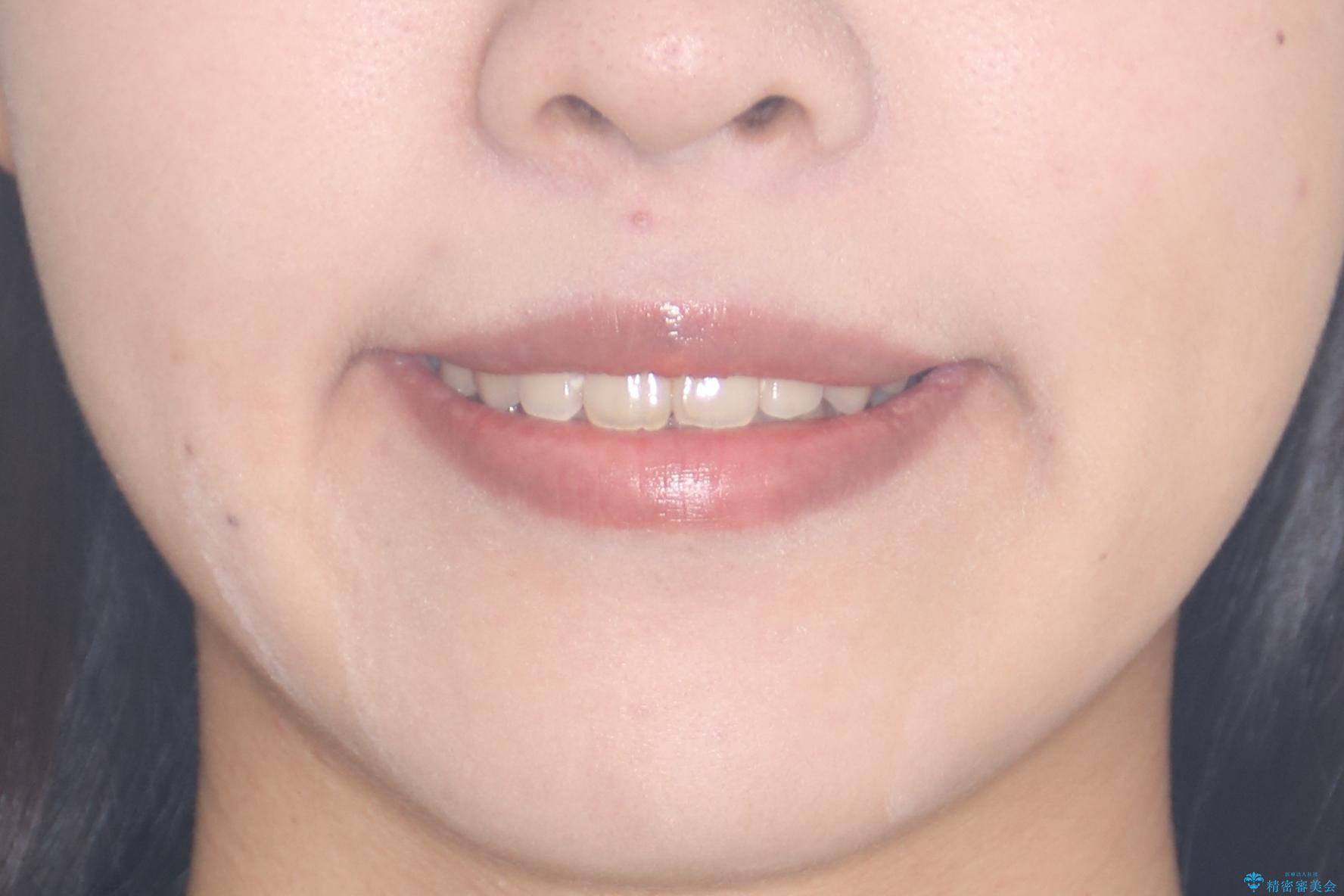 【抜歯矯正】クリア装置で1年半の治療後(顔貌)