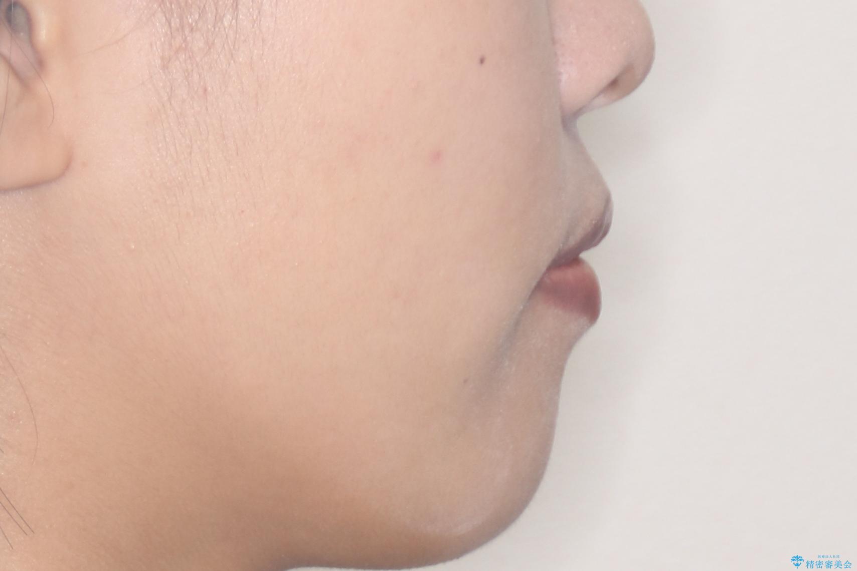 【抜歯矯正】クリア装置で1年半の治療後(顔貌)