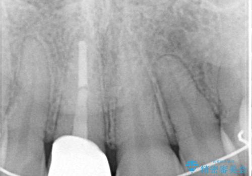 前歯をきれいなセラミックにしたい。の治療後