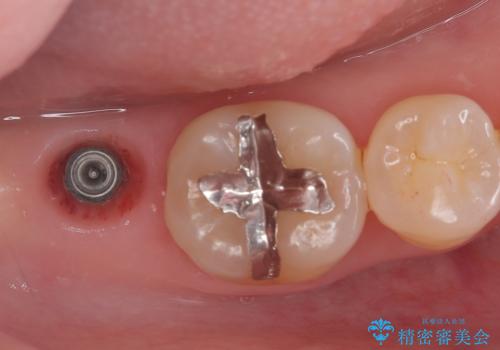 【インプラント】虫歯が大きくて歯を抜いた。の治療中