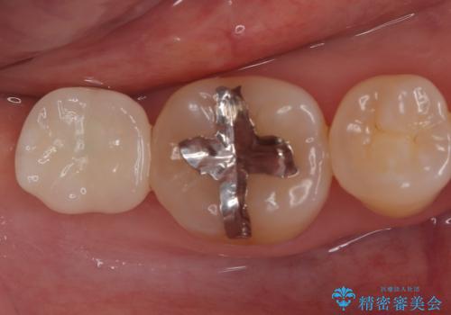 【インプラント】虫歯が大きくて歯を抜いた。の治療後