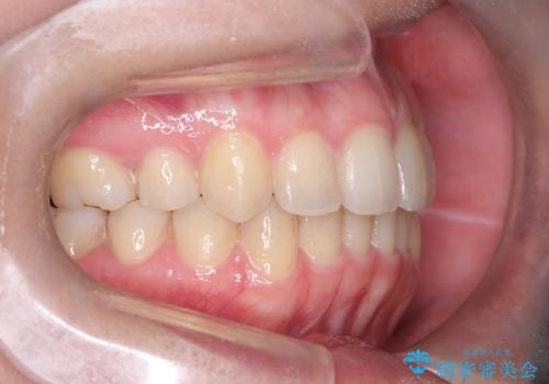 矯正後の後戻り インビザラインで改善の治療後