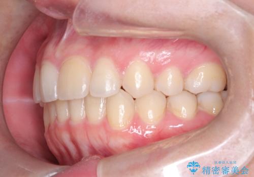 矯正後の後戻り インビザラインで改善の治療後