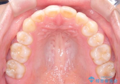矯正後の後戻り インビザラインで改善の治療後