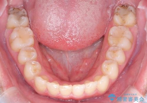 矯正後の後戻り インビザラインで改善の治療後