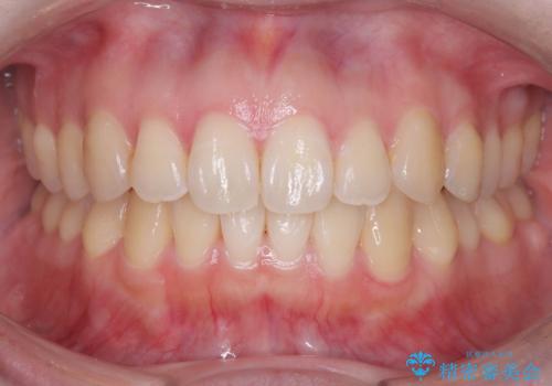 前歯のガタツキをインビザラインで改善の症例 治療後