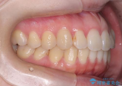 前歯のガタツキをインビザラインで改善の治療後