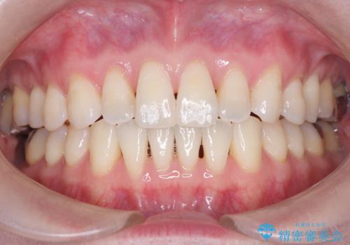 【インビザライン】前歯の捻れとオープンバイト