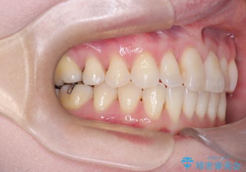 【インビザライン】前歯の捻れとオープンバイトの治療後