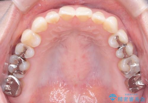 【インビザライン】前歯の捻れとオープンバイトの治療後