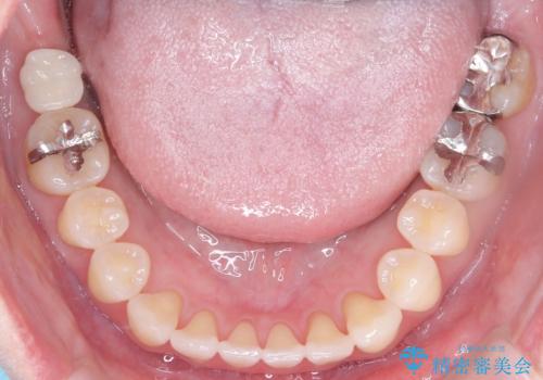 【インビザライン】前歯の捻れとオープンバイトの治療後