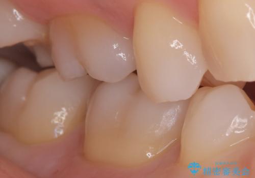 【セラミックインレー】銀歯を外したいの治療前