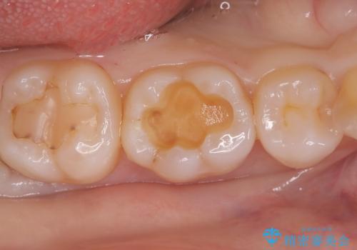 【セラミックインレー】銀歯を外したいの治療中