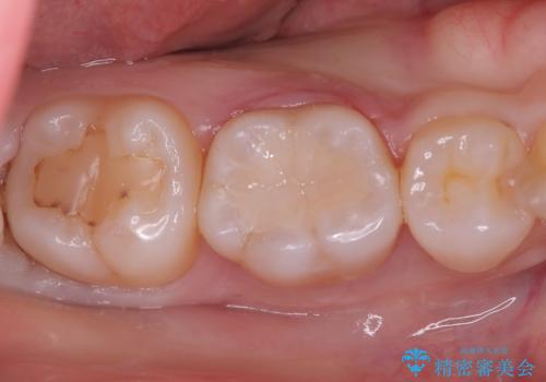 【セラミックインレー】銀歯を外したい