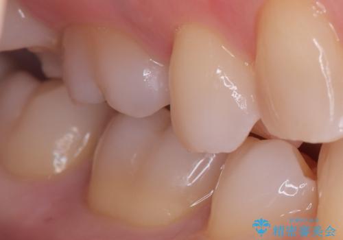【セラミックインレー】銀歯を外したいの治療後
