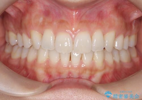 【インビザライン】前歯のねじれを治したいの治療後
