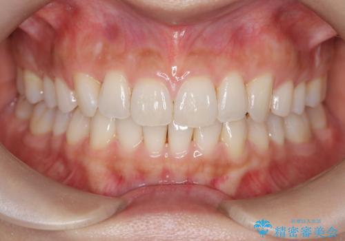 【インビザライン】前歯のねじれを治したい