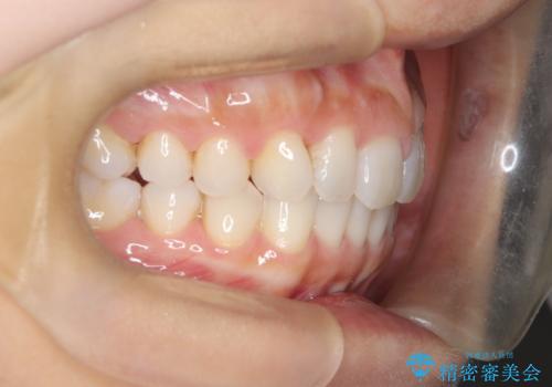 【インビザライン】前歯のねじれを治したいの治療後