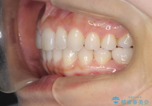 【インビザライン】前歯のねじれを治したいの治療後