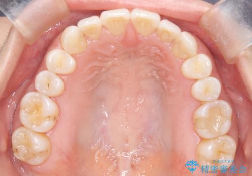 【インビザライン】前歯のねじれを治したいの治療後