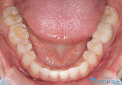 【インビザライン】前歯のねじれを治したいの治療後