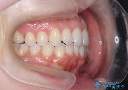 【インビザライン】オープンバイトを治したいの治療後