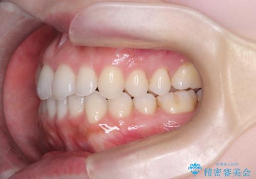 【インビザライン】オープンバイトを治したいの治療後