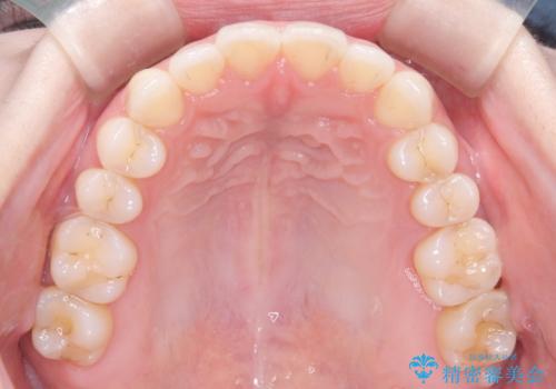 【インビザライン】オープンバイトを治したいの治療後