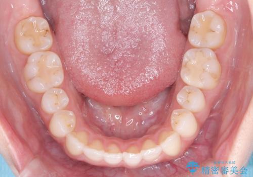 【インビザライン】オープンバイトを治したいの治療後