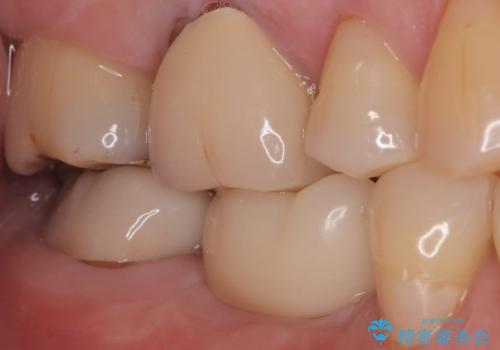 【インプラント】奥歯でしっかり物を噛みたい。の治療後