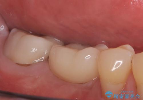【インプラント】奥歯でしっかり物を噛みたい。の治療後