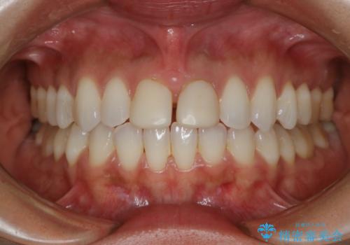 すきっ歯を治したい。インビザライン・ライトによる矯正治療の治療前