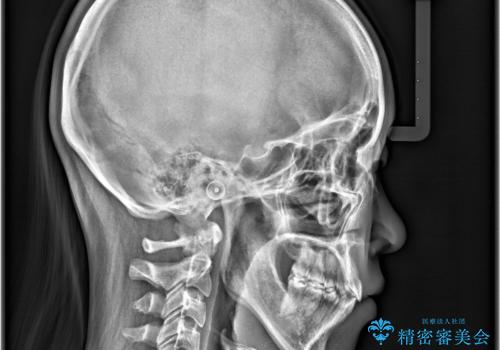 【抜歯矯正】クリア装置で1年半の治療後