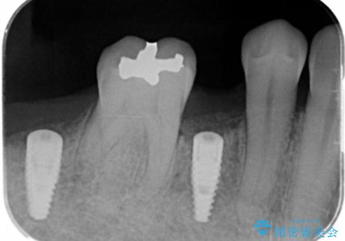 [ 失った歯の機能を回復 ] 奥歯のインプラント治療の治療中