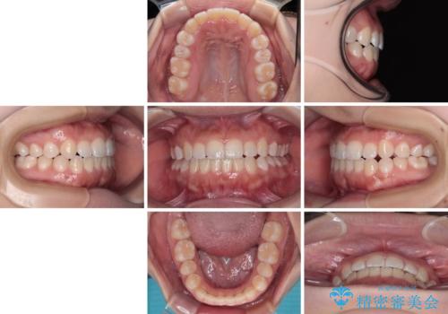 前歯のクロスバイトを改善　インビザライン・モデレートによる矯正治療の治療後