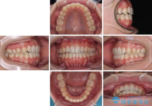 【モニター】オープンバイトをインビザライン矯正で治すの治療後