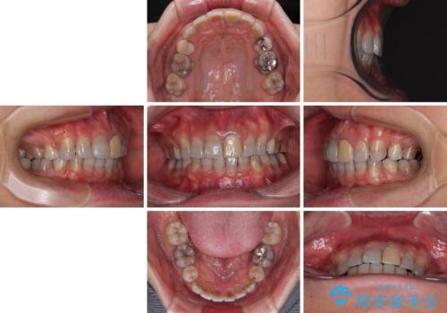 突出した前歯を引っ込める ワイヤー装置での抜歯矯正の治療後