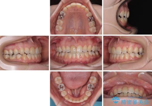 【モニター】後戻りでできた隙間 ワイヤー装置での再矯正の治療後
