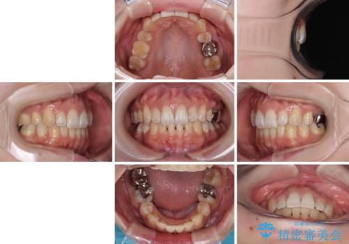 目立たない裏側装置でデコボコをきれいに解消の治療後