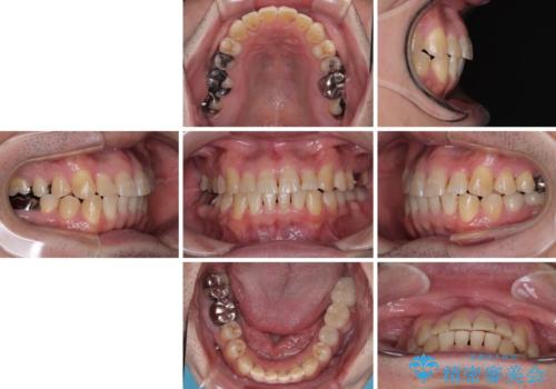 激痛の奥歯のむし歯治療 折角なので矯正治療もしたいの治療後