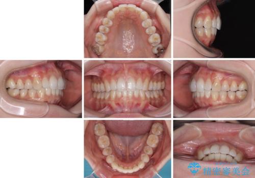 補助装置を用いて奥歯の咬み合わせを事前に改善　インビザラインによる矯正治療の治療後